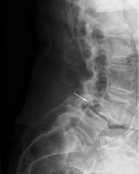 Lumbar-spine-instability