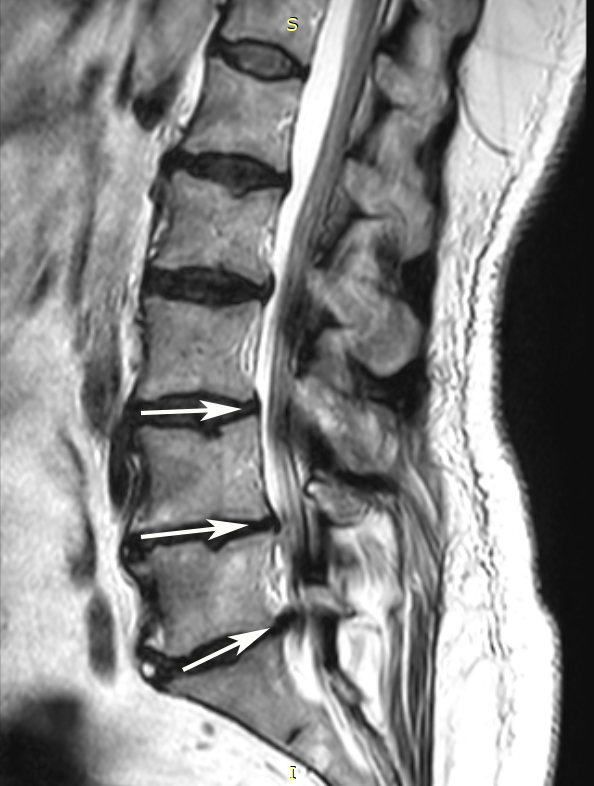 Lumbar spinal stenosis -figure1